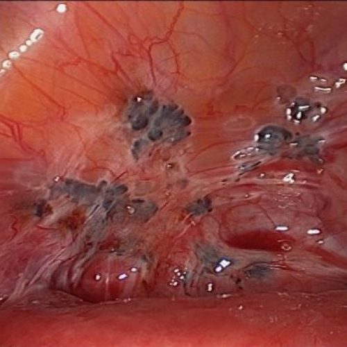 SABÍA USTED QUÉ ES LA ENDOMETRIOSIS?