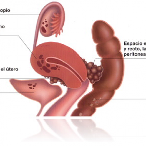 CAUSAS Y SÍNTOMAS DE LA ENDOMETRIOSIS 