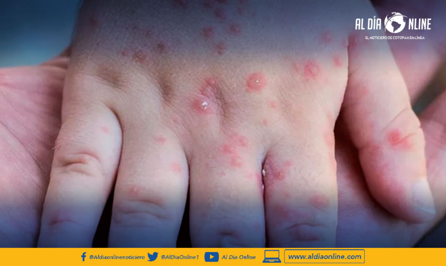 MSP ACTIVA ALERTA EPIDEMIOLÓGICA DE VIRUELA SÍMICA