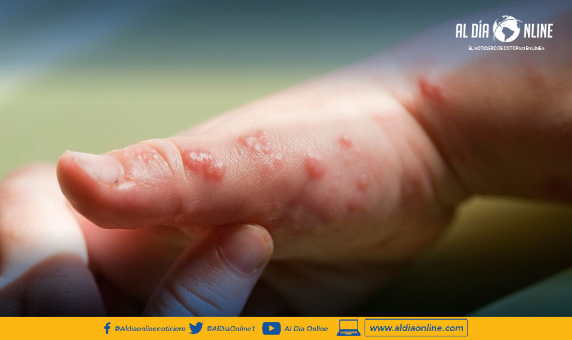 MSP ACTIVA ALERTA EPIDEMIOLÓGICA DE VIRUELA SÍMICA