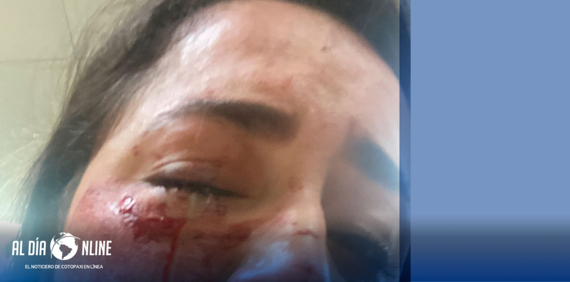 LA ASAMBLEÎSTA VERÓNICA CARRILLO DENUNCIA LA VIOLENTA AGRESIÓN QUE SUFRIÓ EN EL ROSTRO EN UN ASALTO.