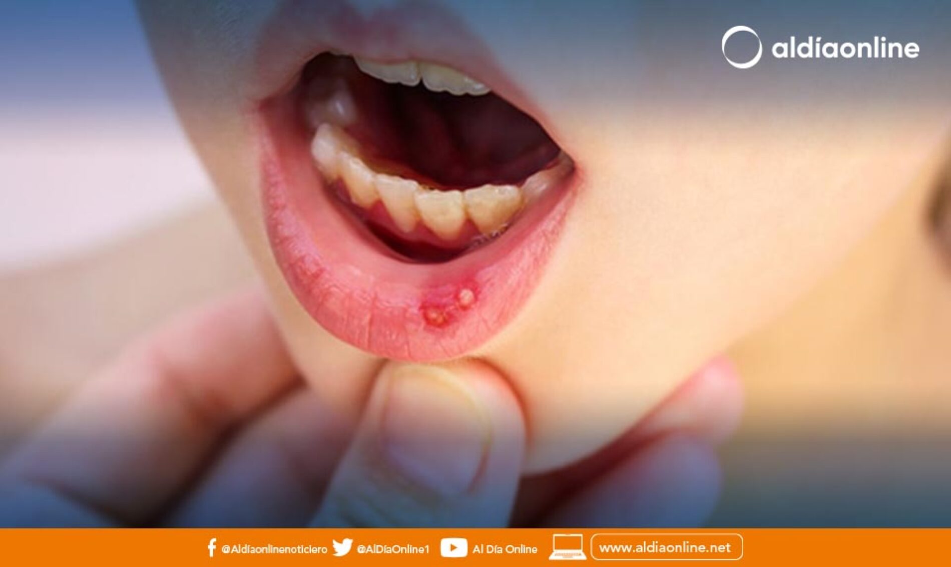 DOS CASOS DE SÍNDROME MANO, PIE, BOCA SE DETECTA EN SAN BUENAVENTURA.(VIDEO)