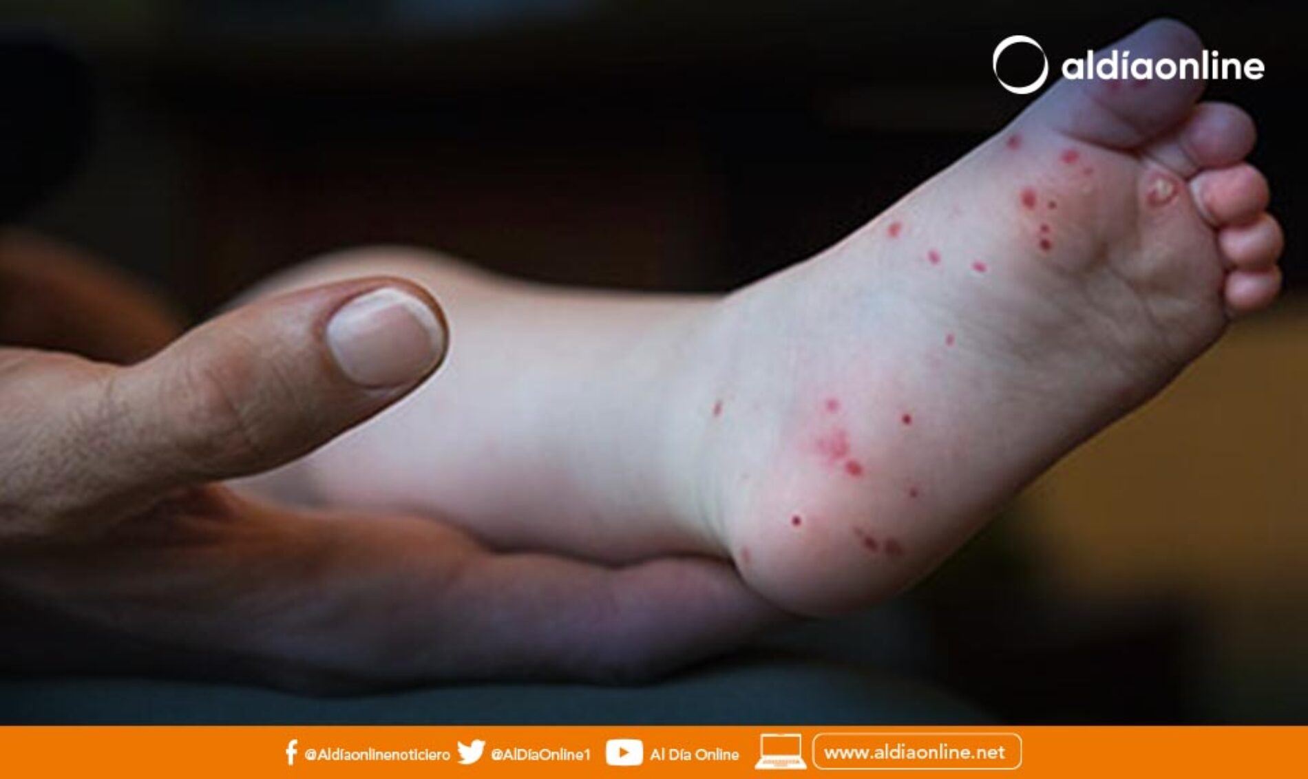 DOS CASOS DE SÍNDROME MANO, PIE, BOCA SE DETECTA EN SAN BUENAVENTURA.(VIDEO)