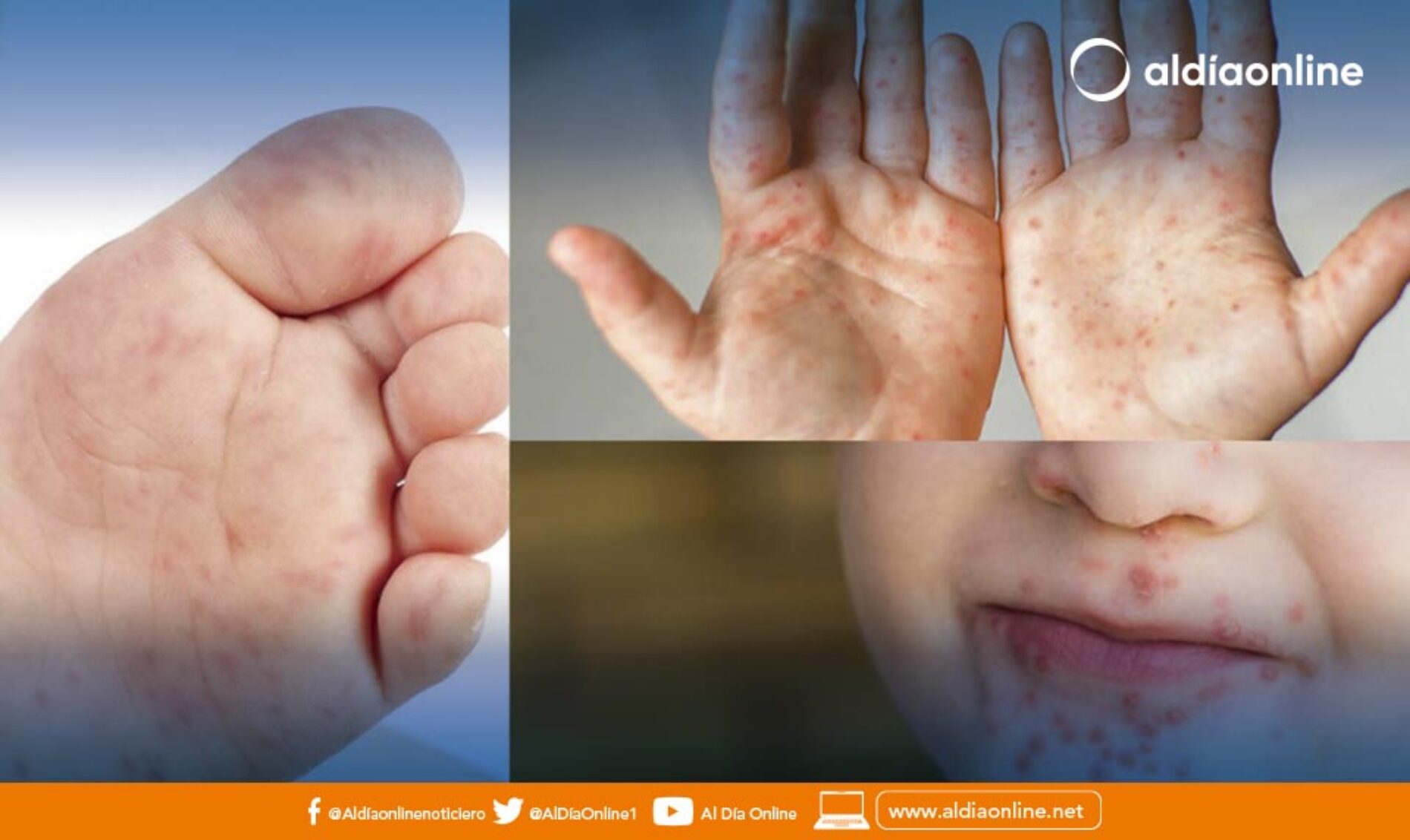 DOS CASOS DE SÍNDROME MANO, PIE, BOCA SE DETECTA EN SAN BUENAVENTURA.(VIDEO)