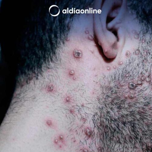 EN ECUADOR NO SE REGISTRAN CASOS POR CEPA MPOX CLADO LB (BROTE NUEVO), DE LA VIRUELA SÍMICA